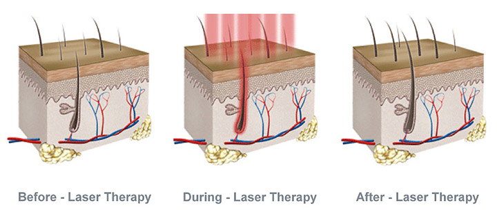 Low Level Laser Therapy Results